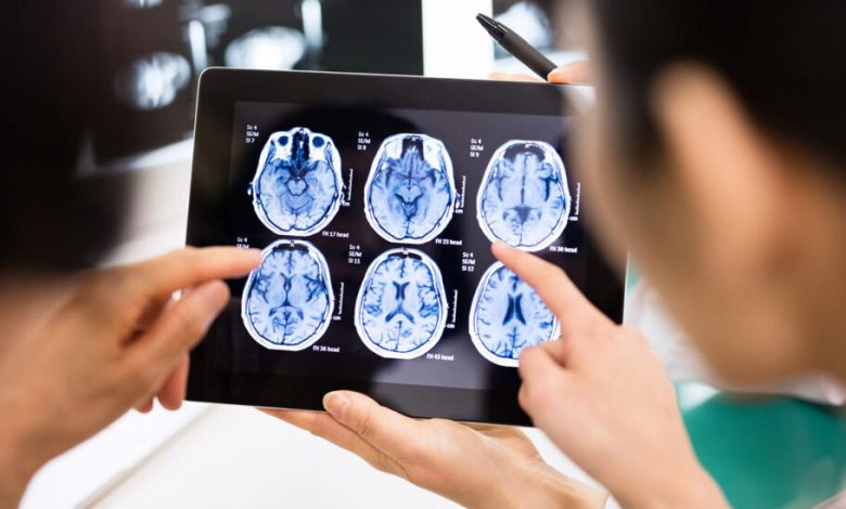 امیدی تازه برای درمان آلزایمر؛ برای اولین‌بار دارویی در آزمایش‌ها سرعت زوال عقل را کاهش داد