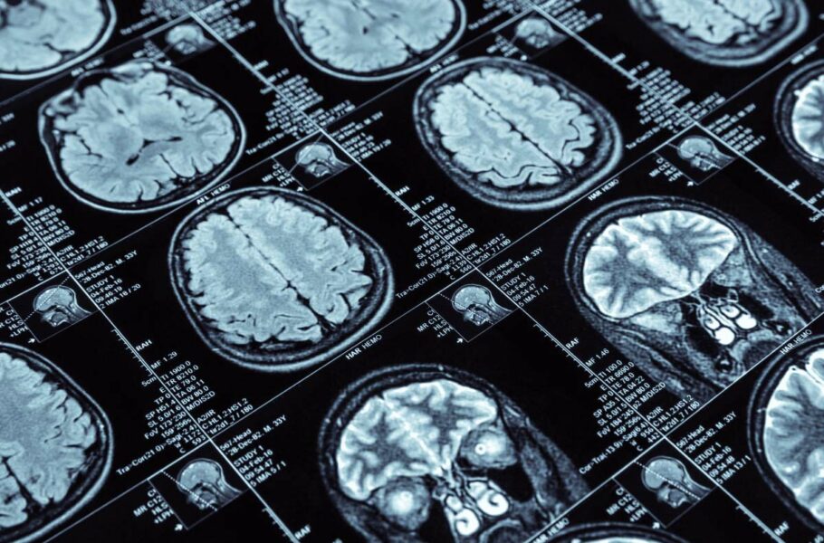 امیدی تازه برای درمان آلزایمر: محققان روشی جدید برای ارسال دارو به درون مغز پیدا کردند