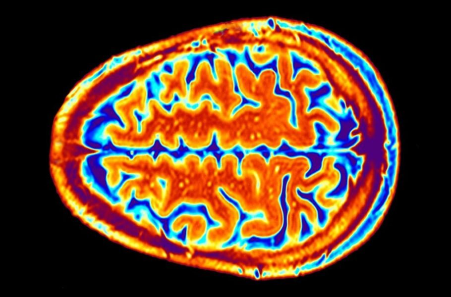 محققان: صافی سطح قشر مغز می‌تواند ریسک ابتلا به افسردگی را افزایش دهد