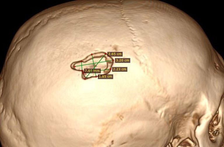 کنترل رؤیا با ایمپلنت مغزی؛ یک محقق روسی با دریل جمجمه‌اش را سوراخ کرد و در مغزش تراشه کاشت!