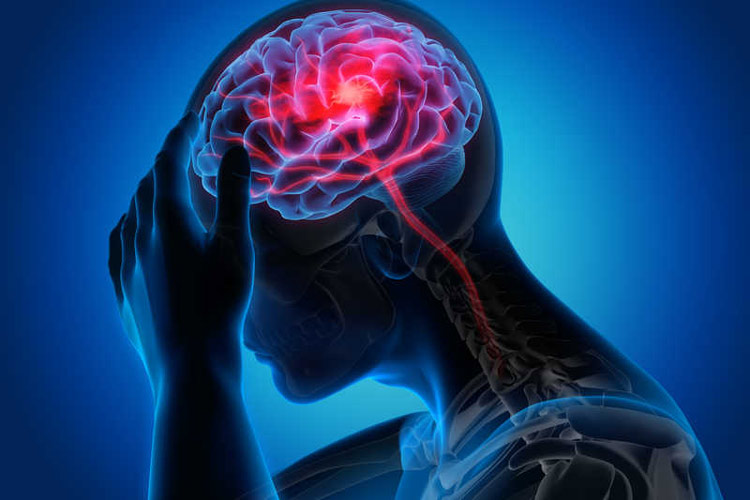 سکته مغزی چیست؟ چه علائم و درمان‌هایی دارد؟