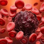 روش جدید نوردرمانی در نیم ساعت، ۹۰ درصد از سلول‌های سرطانی را از بین می‌برد